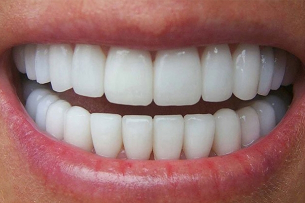 Răng sứ không kim loại là gì? Ưu điểm, nhược điểm và giá cả