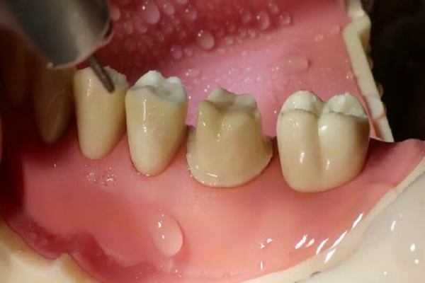 Cùi răng sứ giả là gì? Cần làm cùi răng sứ giả khi nào?
