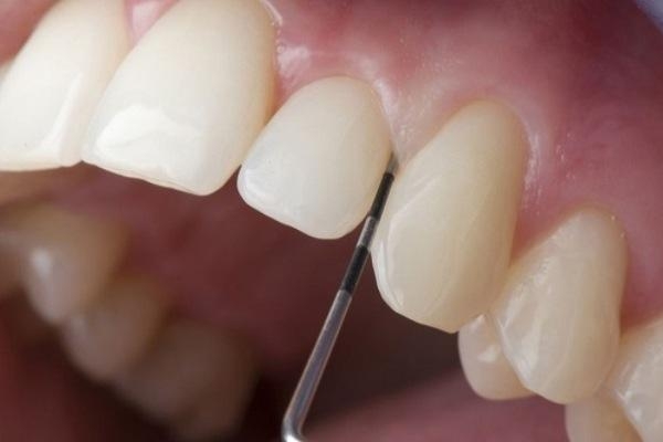 Quy trình làm cùi răng sứ diễn ra như thế nào?