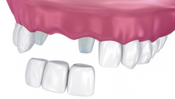 Cầu răng sứ là lựa chọn phổ biến cho người bị mất răng cửa