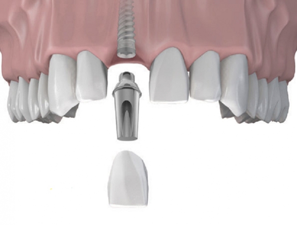 Răng Implant là phương pháp thay thế răng vĩnh viễn bằng titan