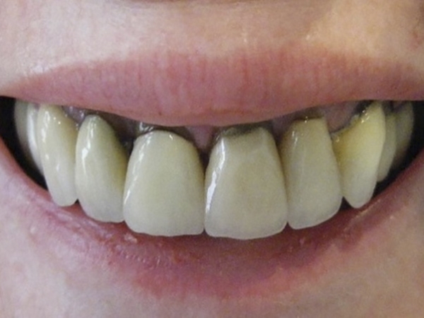 Tác hại của răng sứ kim loại - Những điều cần lưu ý